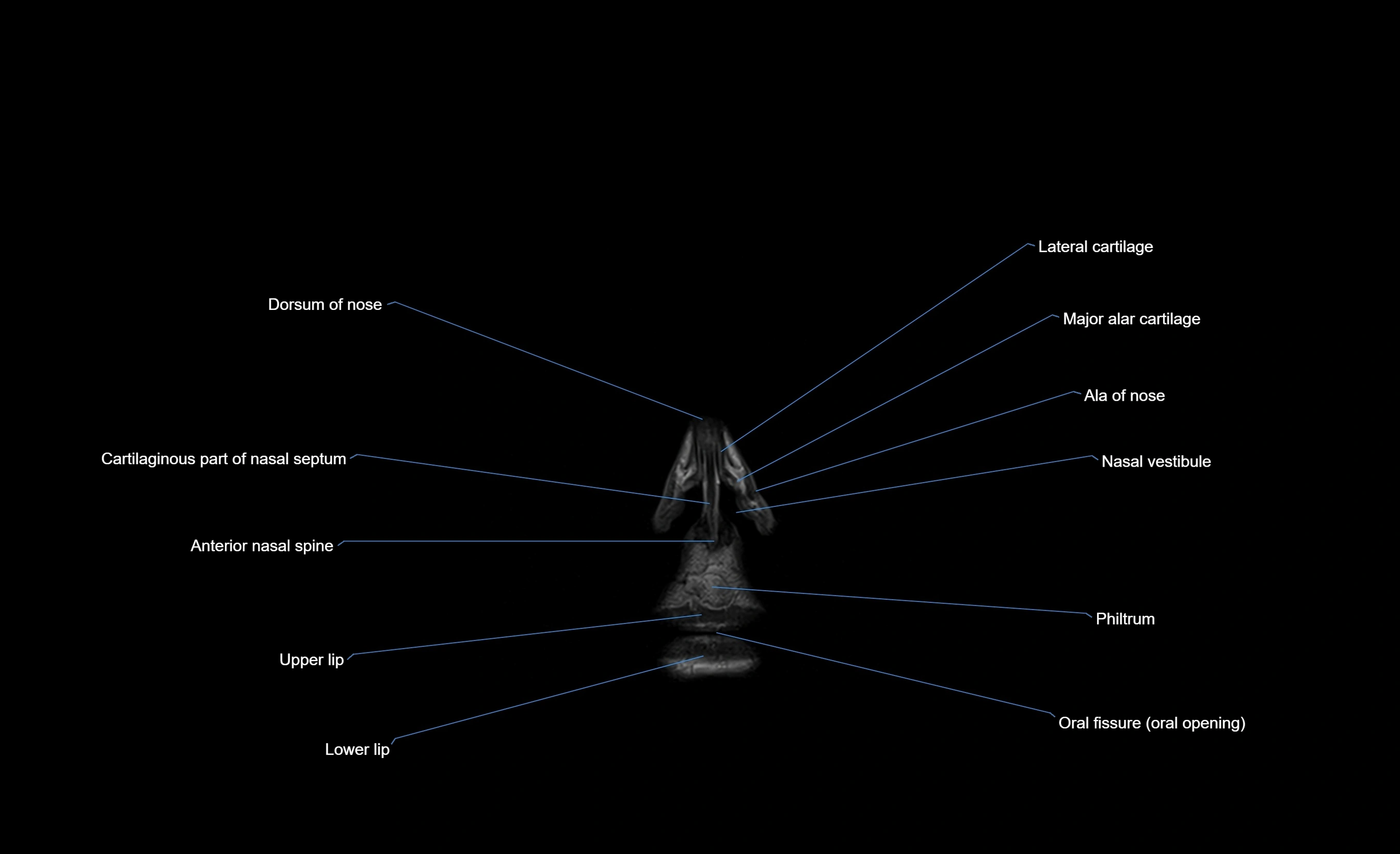 MRI face & paranasal sinuses(PNS) labelled  coronal  cross sectional anatomy 3T radiology  image-img-00001-00005.webp